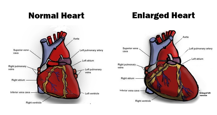 What to know about cardiomegaly