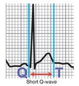 Cleveland clinic - short qt syndrome
