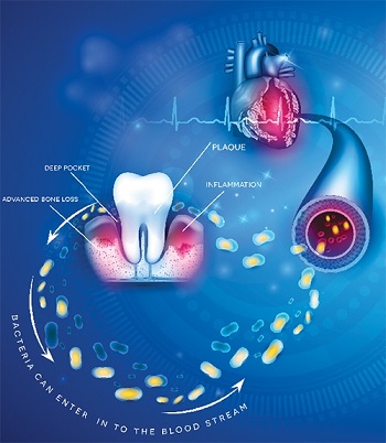 The heart—dental health relationship