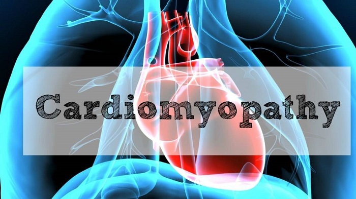 All you need to know about Cardiomyopathy!