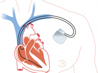 SafeBeat Initiative: ICDs Life-Saving—but Risky—for Children with ...