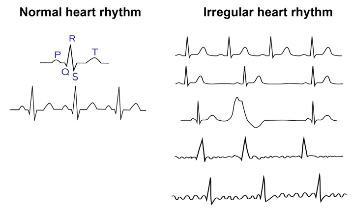 ecg-educator-blog-sinoatrial-node-rhythms