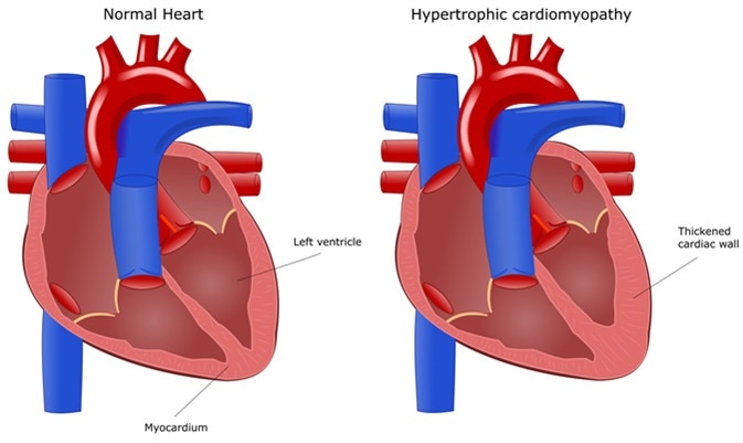 Hypertrophic Cardiomyopathy (HCM)