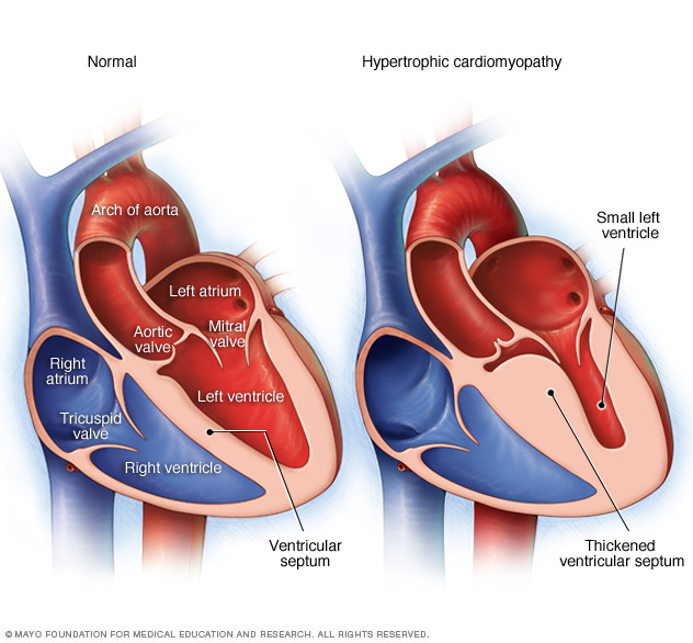 mayo clinic - hypertrophic cariomyopathy